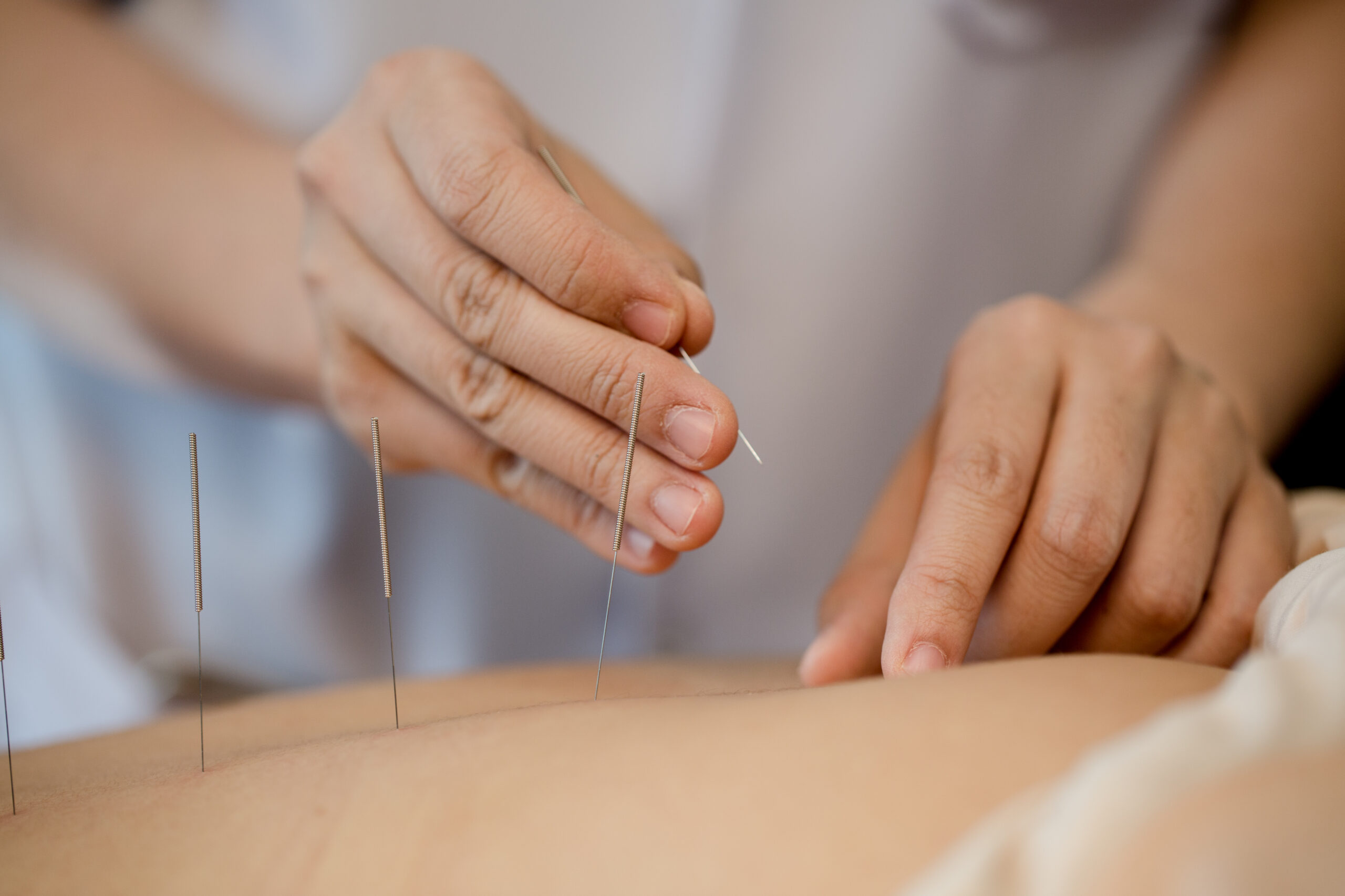 young-woman-undergoing-acupuncture-treatment